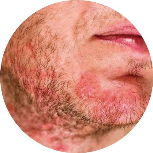 患有玫瑰痤瘡