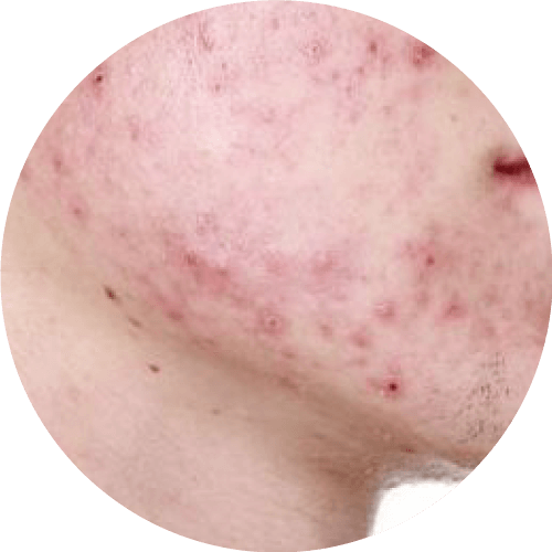 暗瘡嚴重爆發人士