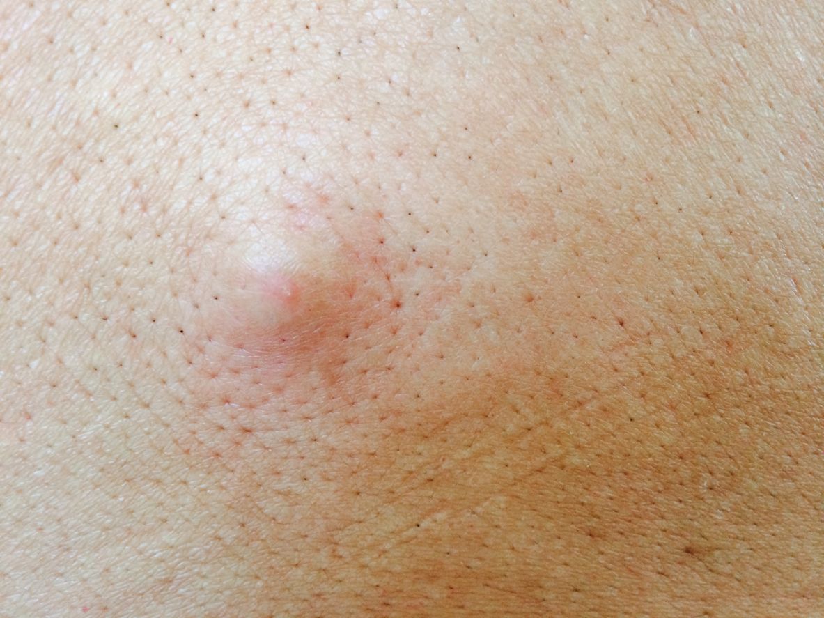 面上凸起顆狀物