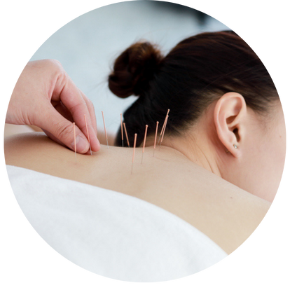 針灸治療