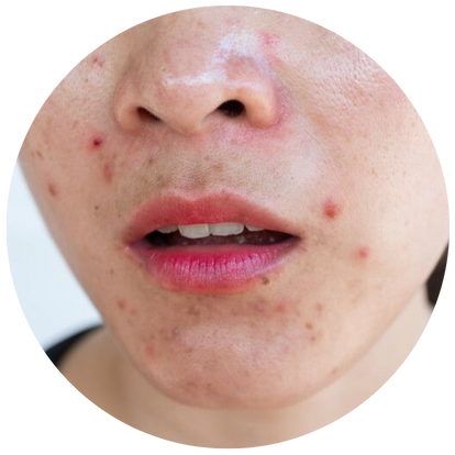 油脂分泌旺盛型