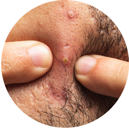 瘀黑色眉心暗瘡