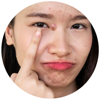 增加產生暗瘡、
粉刺的機會