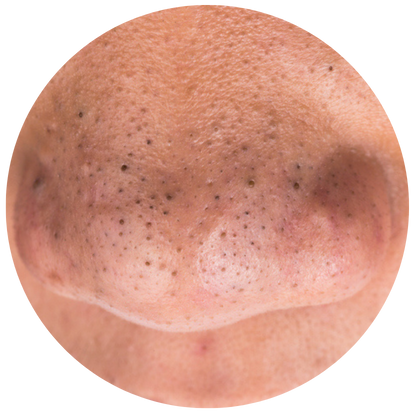 黑頭粉刺嚴重者