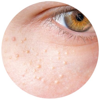  專家助你擺脫反覆嘅皮膚敏感粒粒！