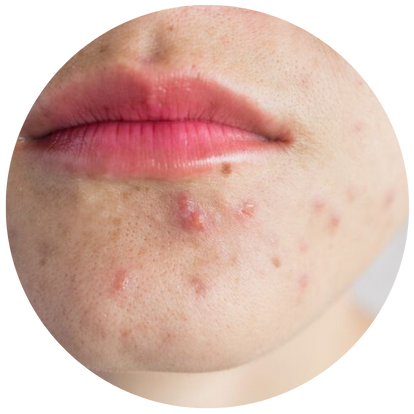 乾燥老化型毛孔