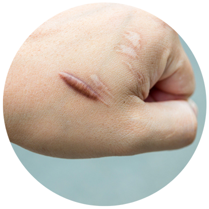 屬於疤痕體質的人士