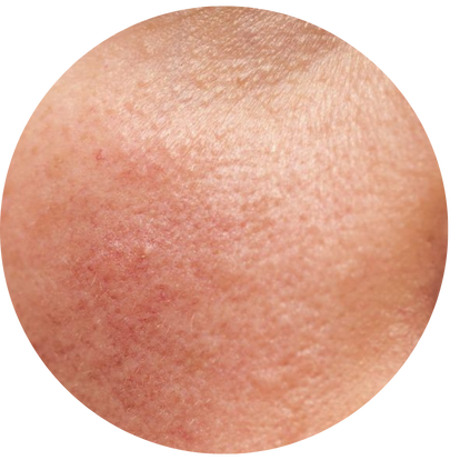 出現丘疹影響外觀