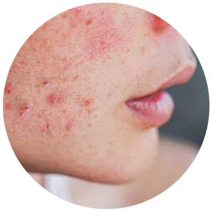 增加產生暗瘡的機會