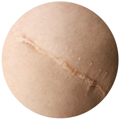 有蟹足腫體質的人士