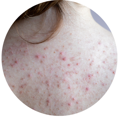 背部暗瘡的形態