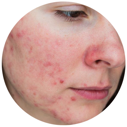 容易留下暗瘡印、暗瘡疤