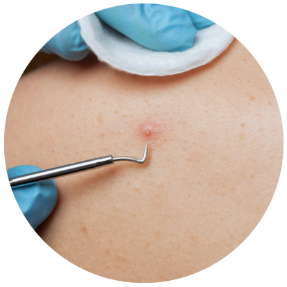 背部暗瘡的膿頭