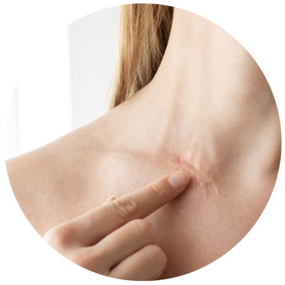 留下永久性疤痕