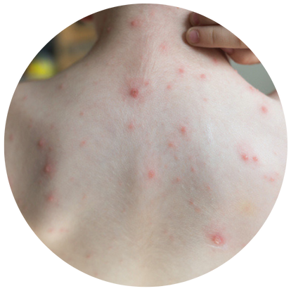 背部暗瘡的顏色