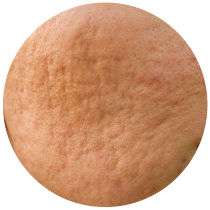 皮膚永久性疤痕