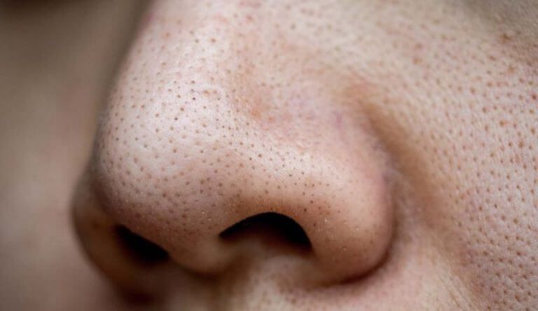 容易長黑頭、粉刺