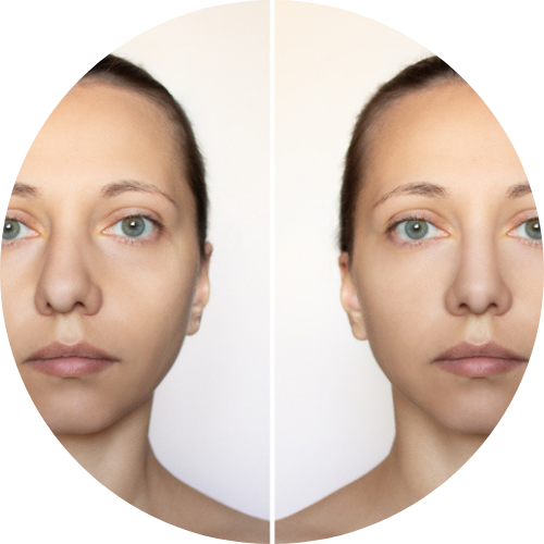 進行角質控制療程