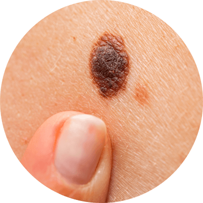 色塊呈圓形或橢圓形