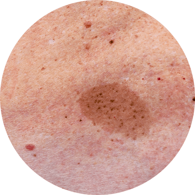 皮膚出現深色色塊