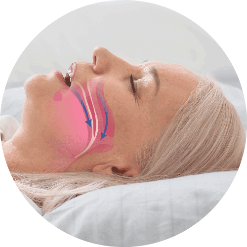 中樞型睡眠窒息症