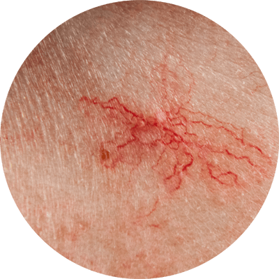 有蟹足腫體質的人士