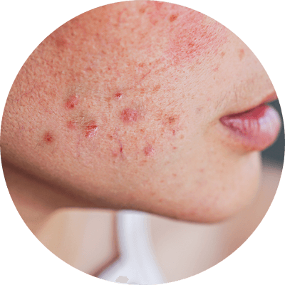 慢性皮膚病患者