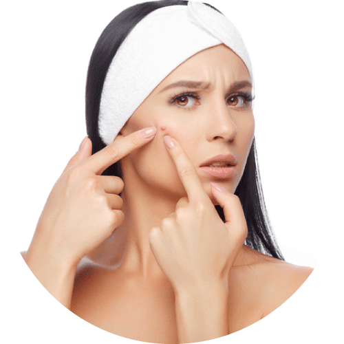 避免用手擠壓暗瘡、粉刺