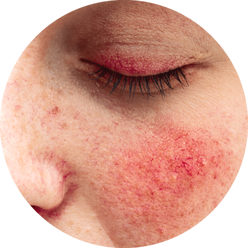 玫瑰痤瘡