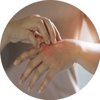 有蟹足腫體質的人士