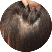 病理性脫髮人士