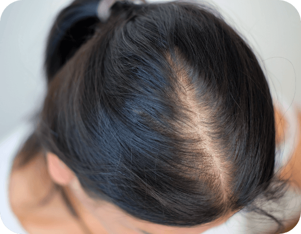 女性禿頭年輕化 