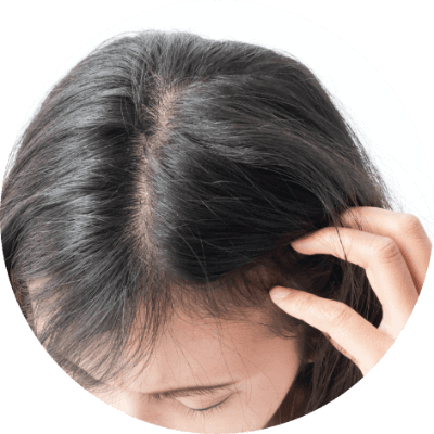 前額脫髮