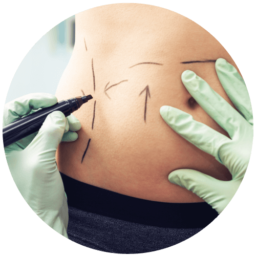 肚臍下腹直肌分離